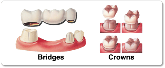 Experiencing Dental Bridge Discomfort? Schedule An Appointment with Associates of Dentistry