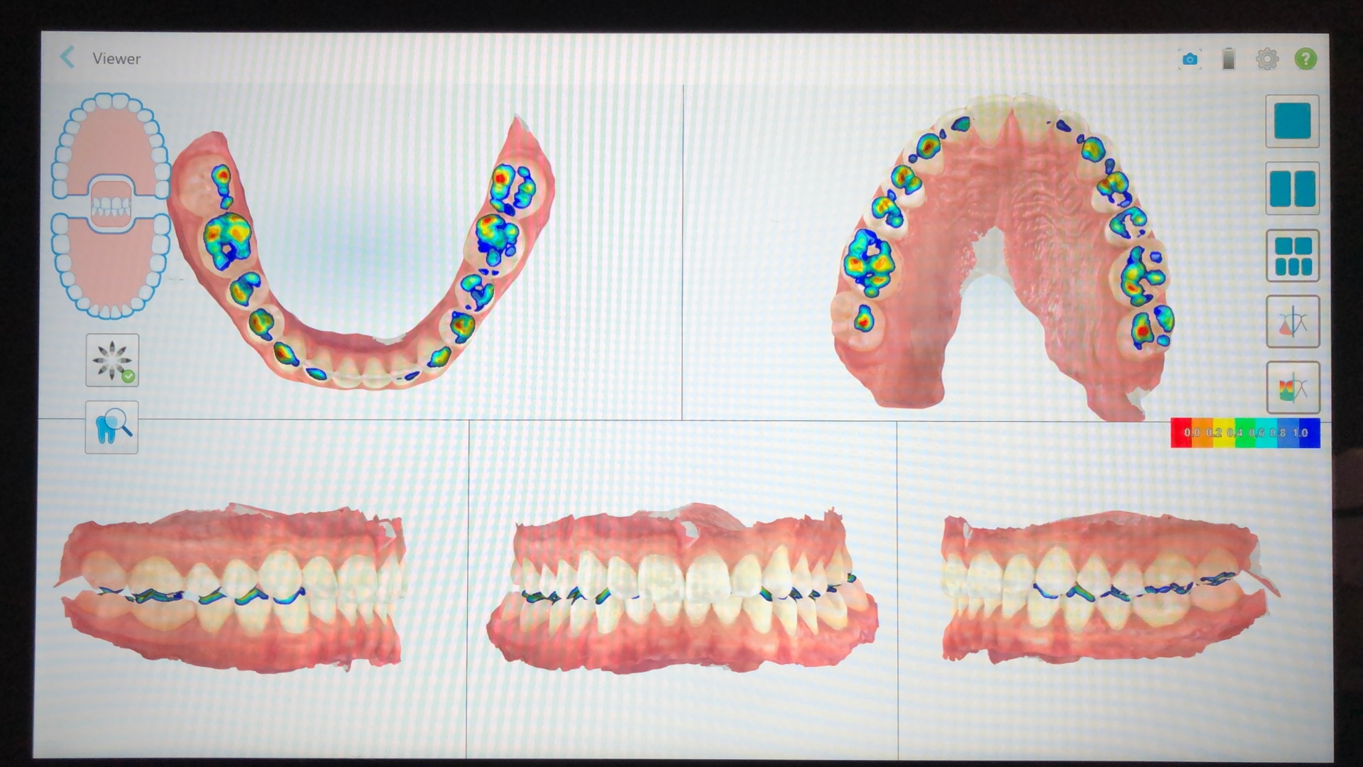 What Is an iTero Machine? | Journey to a Straighter Smile – Associates ...